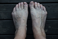 Minimally Invasive Bunionette Surgery